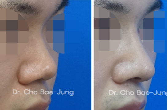  | Korea's Top Nose Revision Specialist